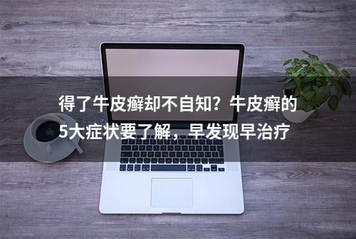 得了牛皮癣却不自知？牛皮癣的5大症状要了解，早发现早治疗